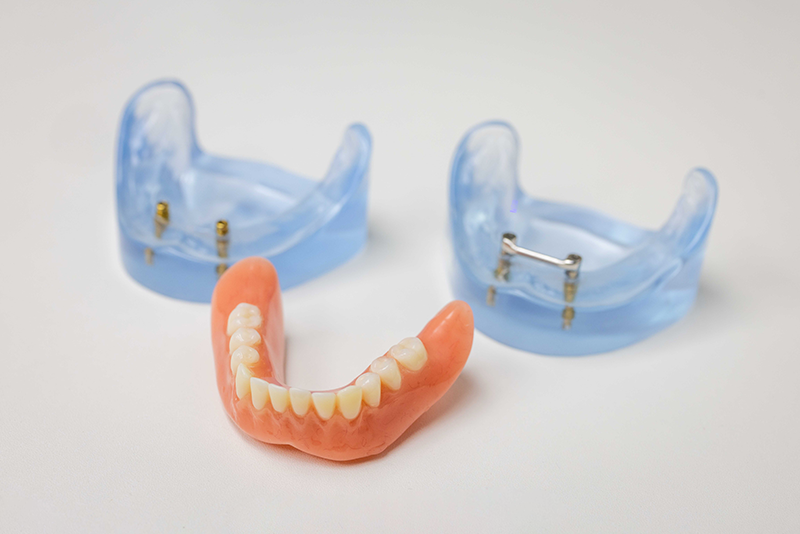 implantaten